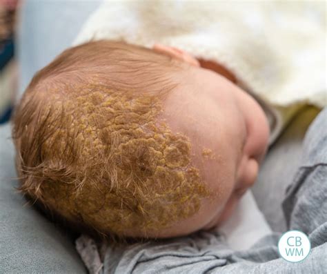 cradle cap in the elderly|Cradle cap .